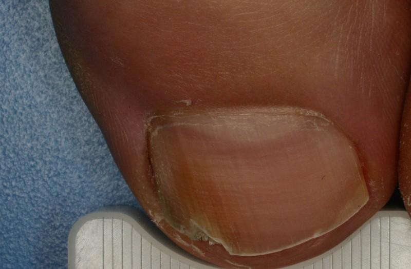 hogyan kell kezelni a köröm gomba a lábát a gyógyszert nail fungus treatment laser