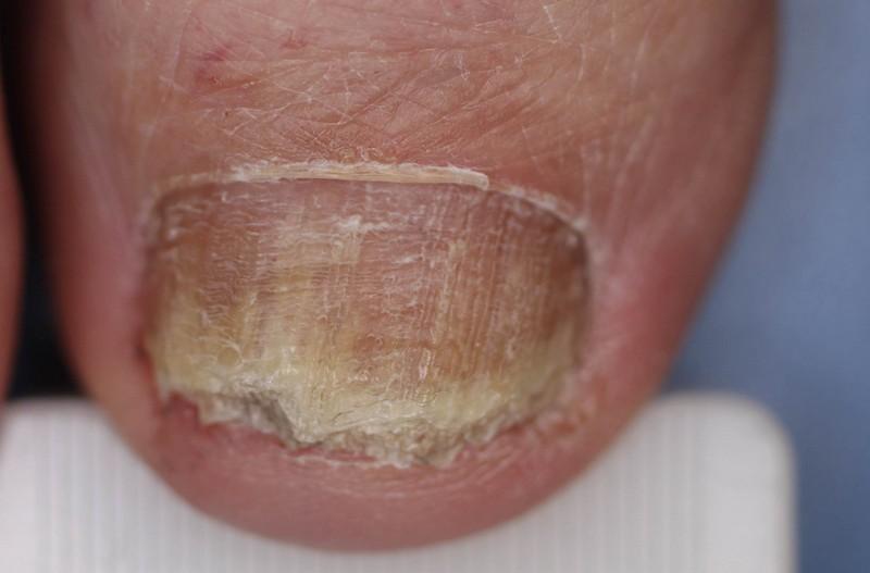 az onkomicosis gomba kezelése a köröm lábán