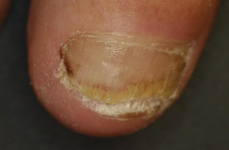 lehet gomba a köröm alatt nail gombák helyi kezelés